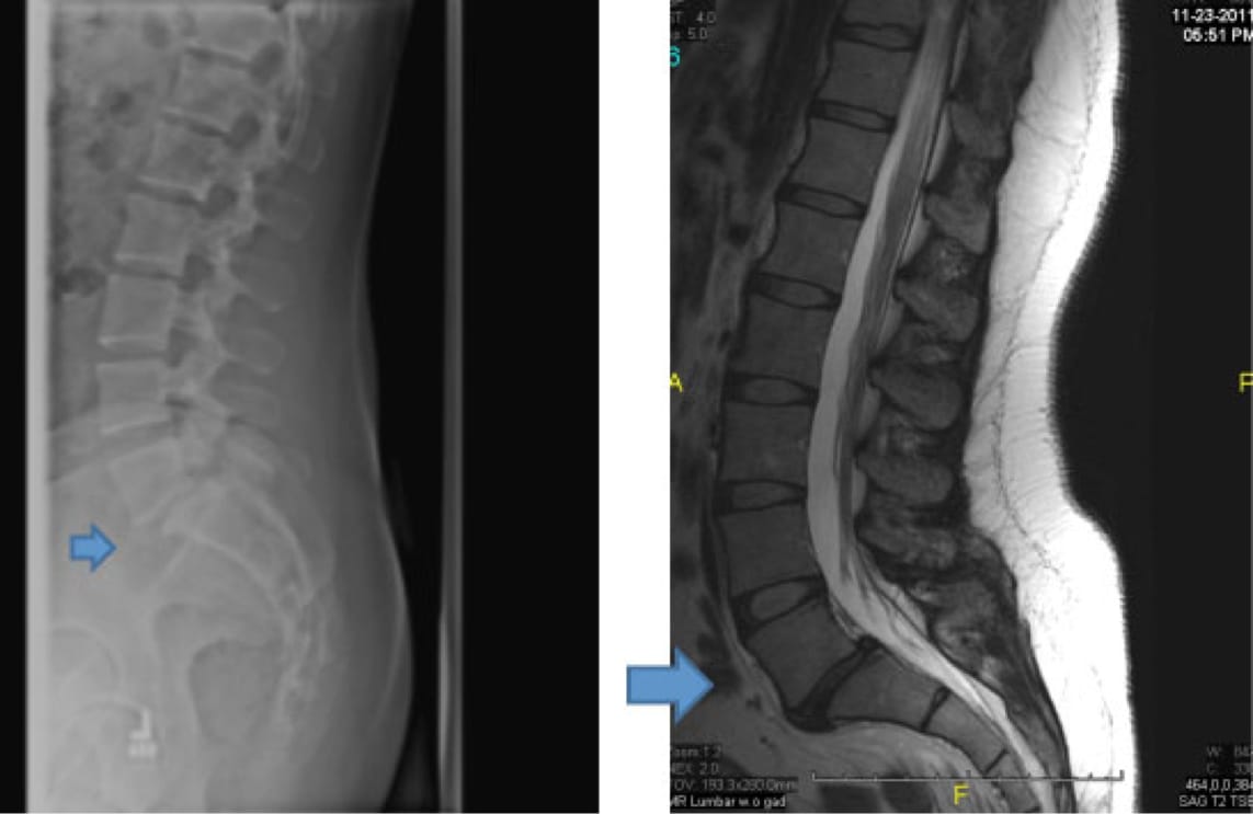 Isthmic Spondylolishthesis NYC