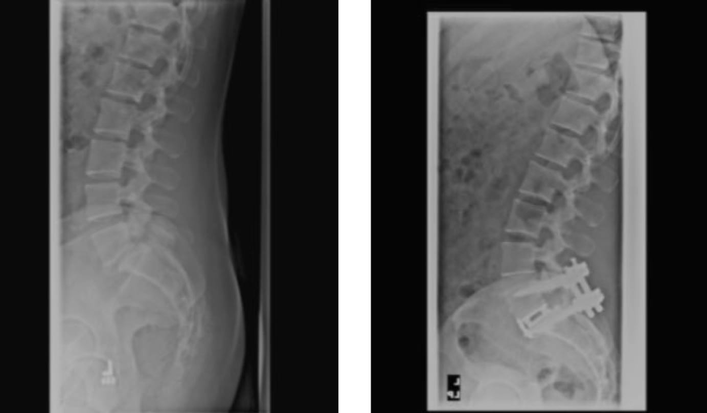 Isthmic Spondylolishthesis NYC