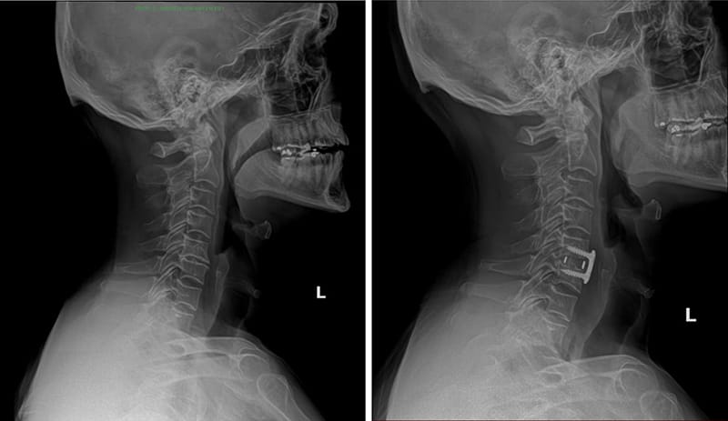 Anterior Cervical Discectomy and Fusion