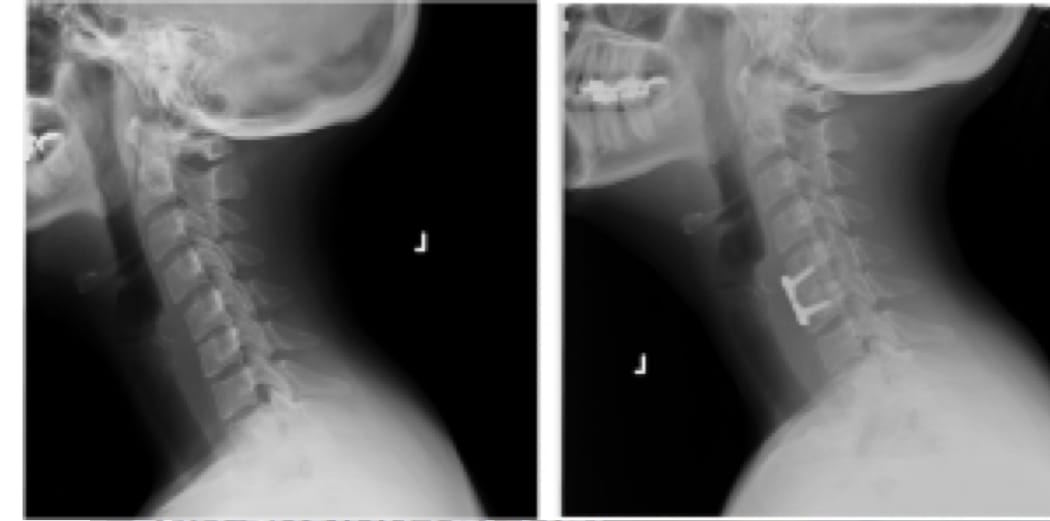 Anterior Cervical Discectomy and Fusion