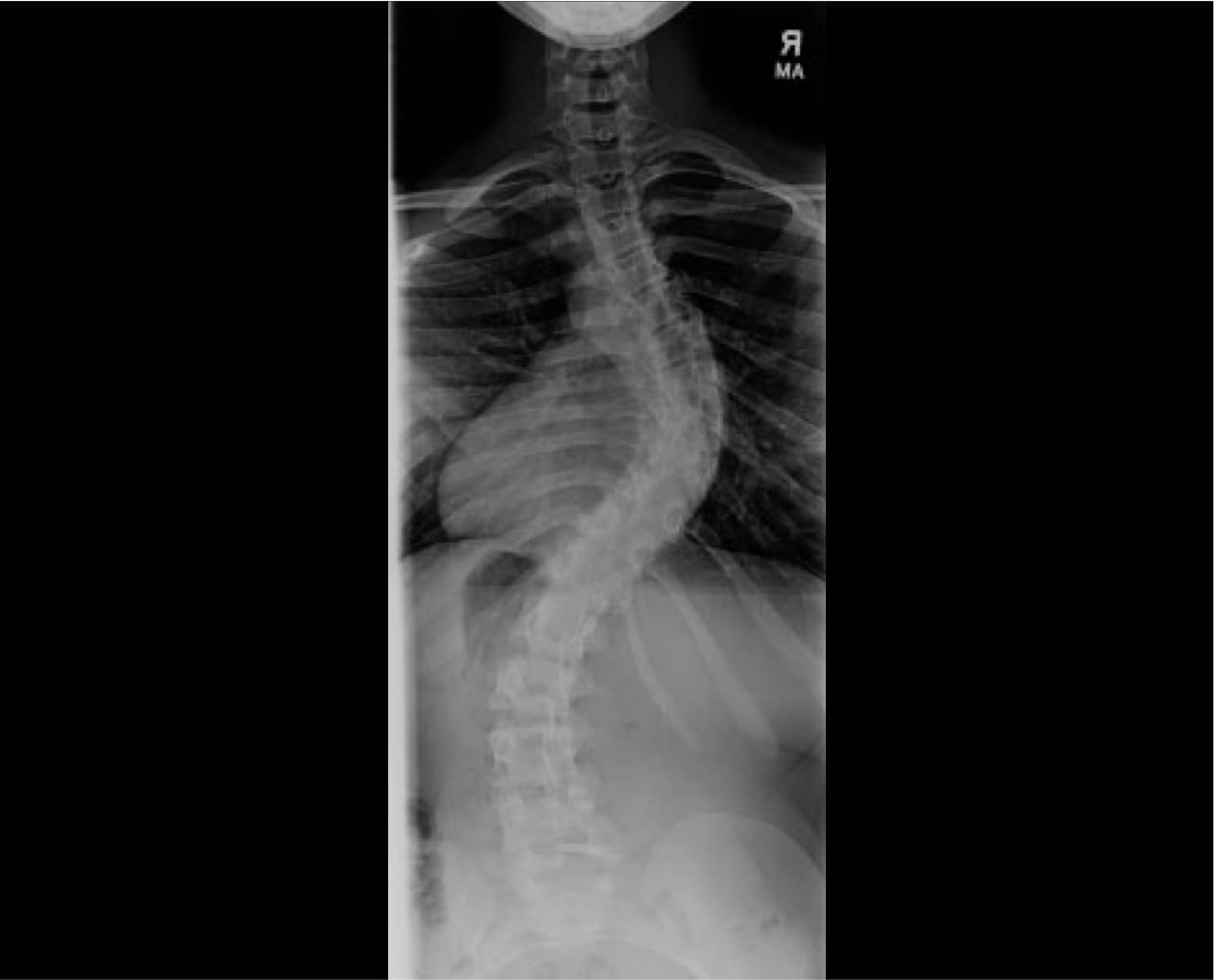 Adolescent Idiopathic Scoliosis Case Study 2, OrthoManhattan