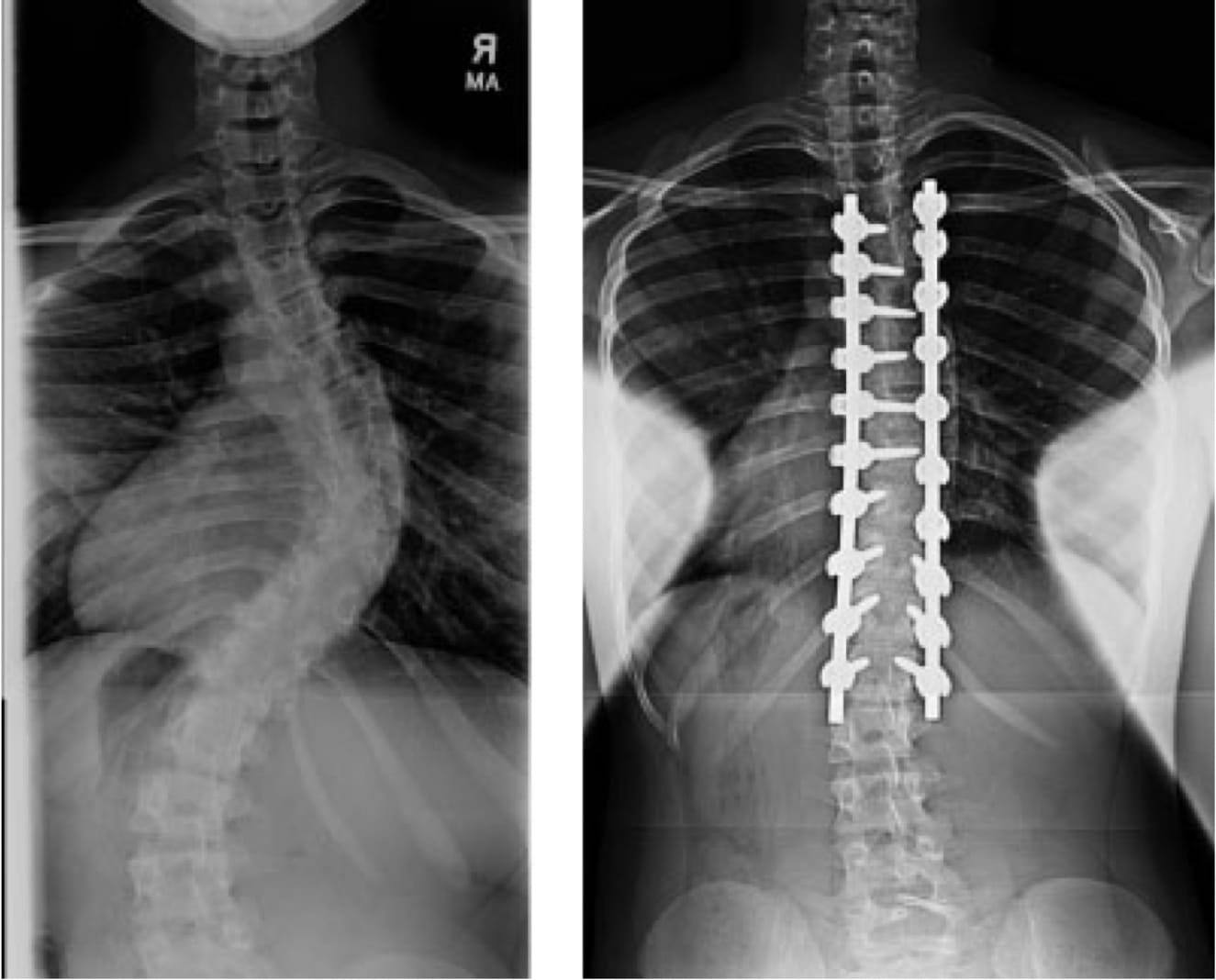 Adolescent Idiopathic Scoliosis Case Study 2, OrthoManhattan