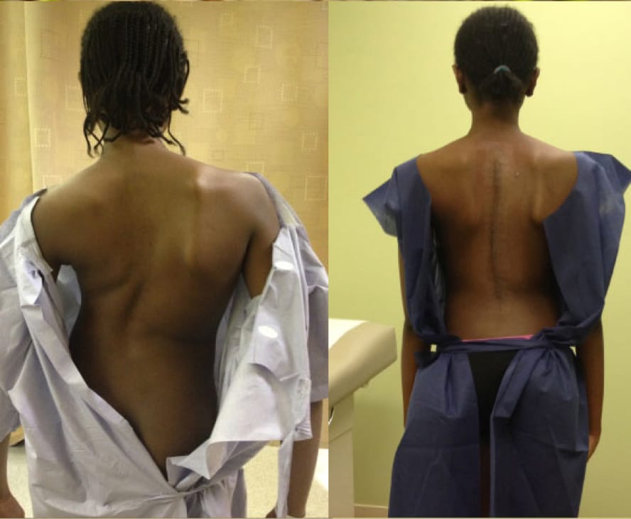 Adolescent Idiopathic Scoliosis Case Study 2, OrthoManhattan