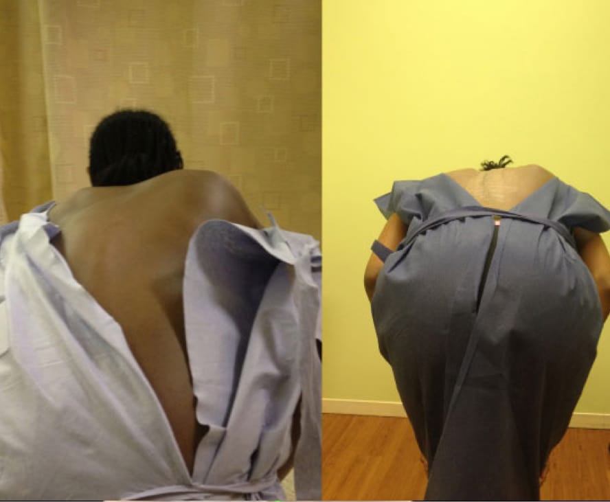 Adolescent Idiopathic Scoliosis Case Study 2, OrthoManhattan