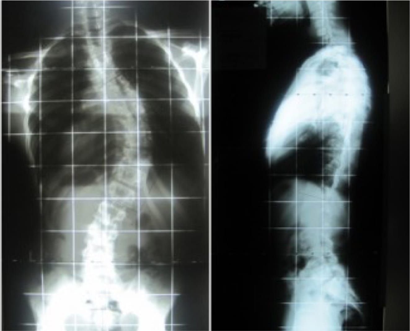 Case Study: Adolescent Idiopathic Scoliosis, OrthoManhattan