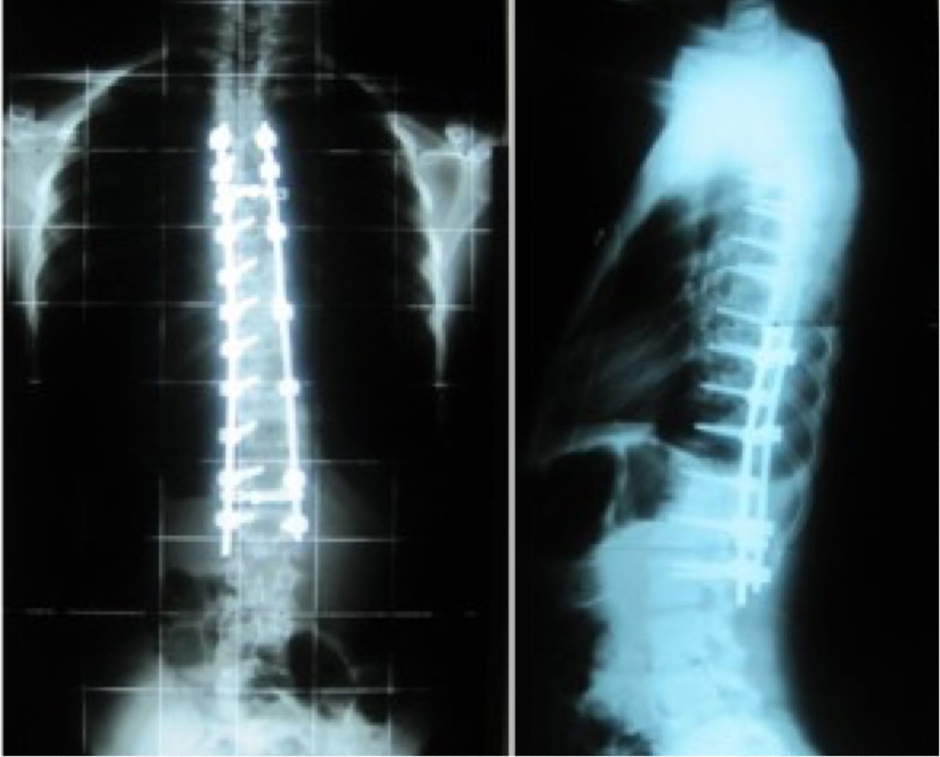 Case Study: Adolescent Idiopathic Scoliosis, OrthoManhattan