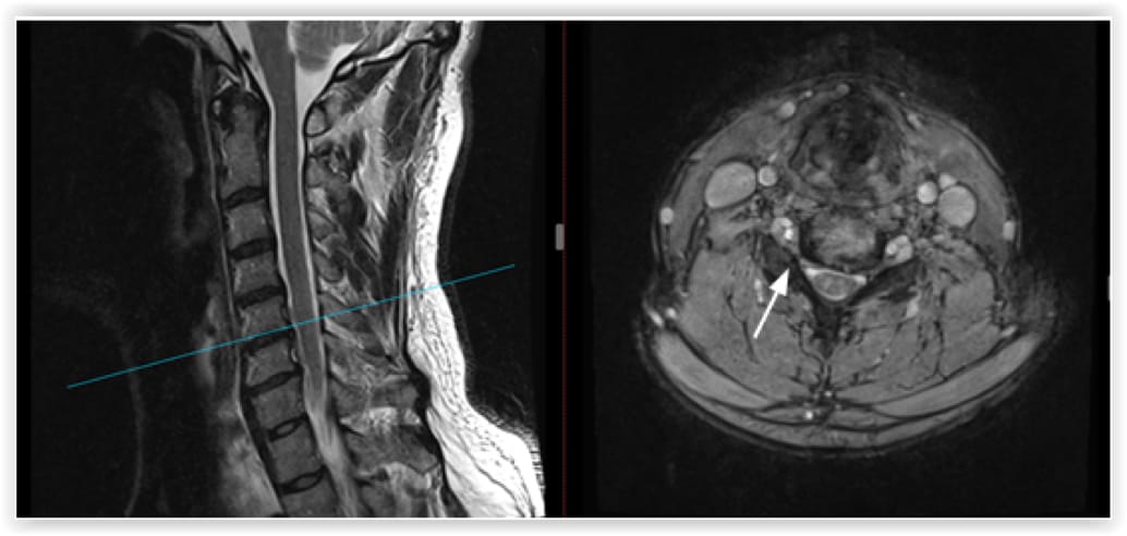 Cervical Foraminotomy, OrthoManhattan