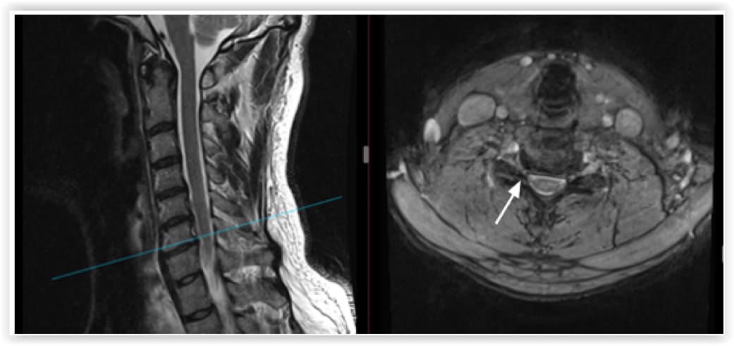 Cervical Foraminotomy, OrthoManhattan