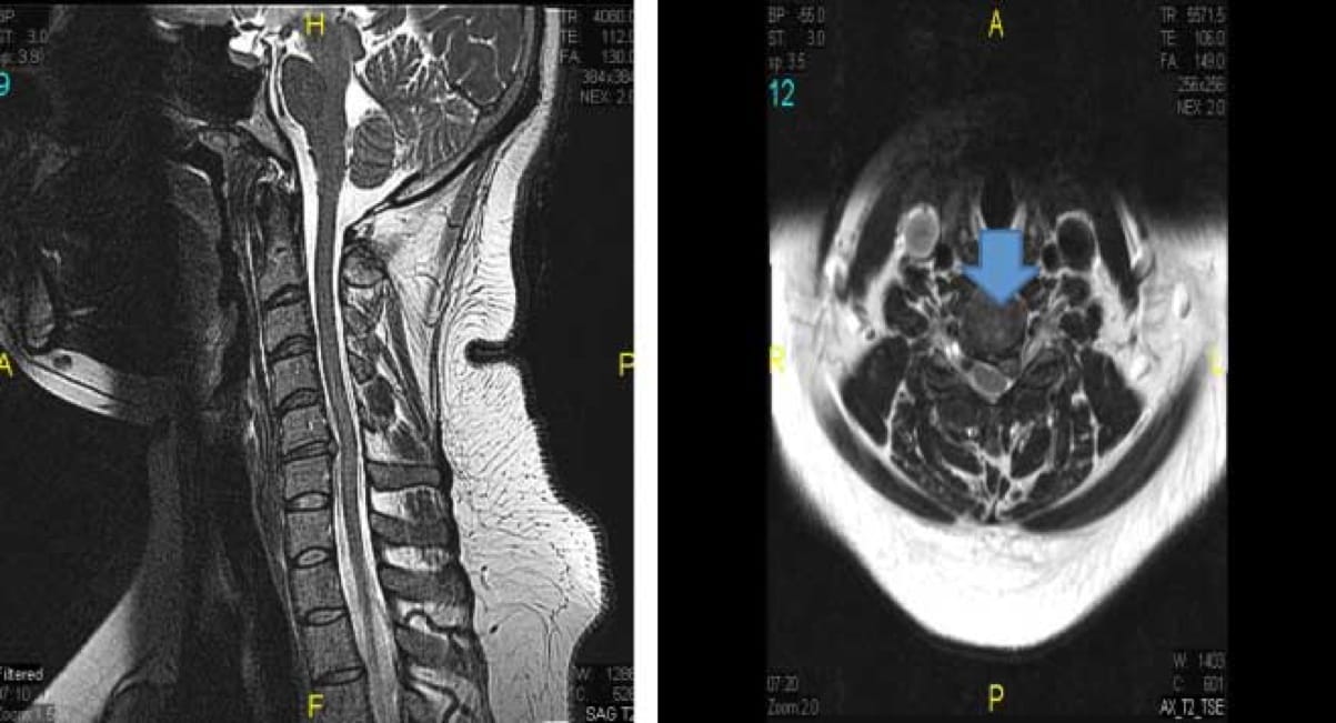 Cervical Herniated Disc, OrthoManhattan