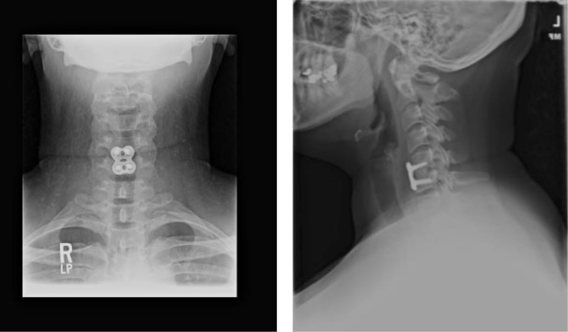 Cervical Herniated Disc, OrthoManhattan