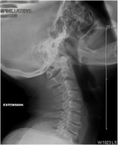 Cervical Myelopathy, OrthoManhattan