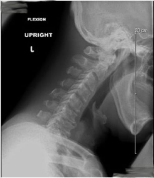 Cervical Myelopathy, OrthoManhattan