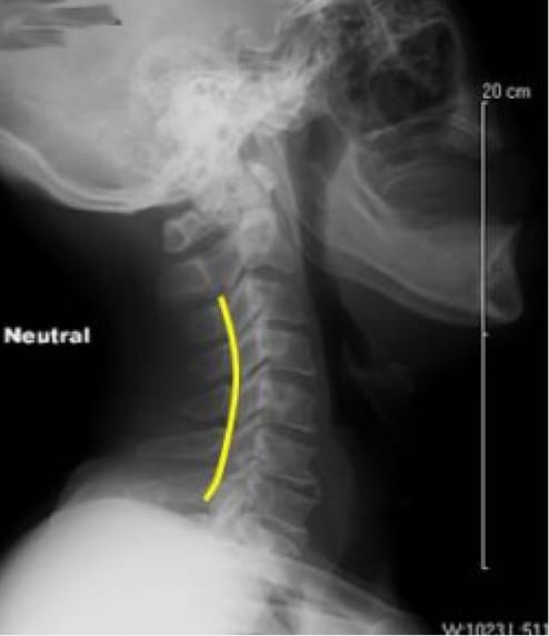 Cervical Myelopathy, OrthoManhattan