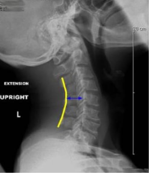 Cervical Myelopathy, OrthoManhattan