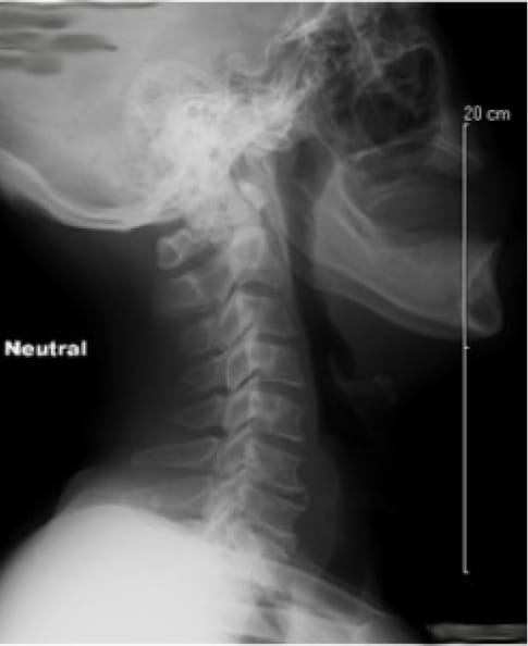 Cervical Myelopathy, OrthoManhattan