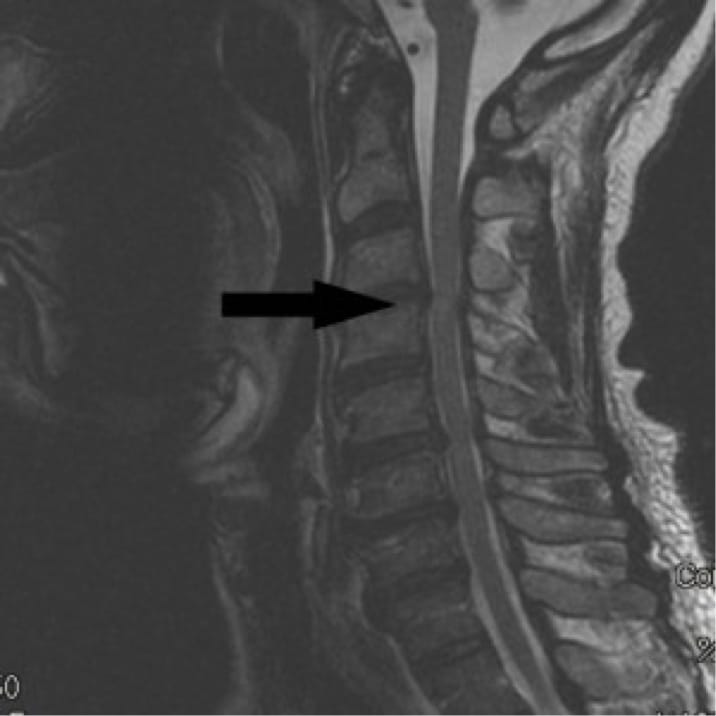 Cervical Myelopathy Orthomanhattan