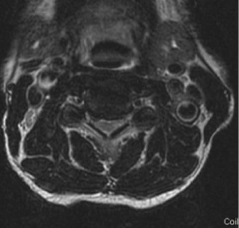 Cervical Myelopathy, OrthoManhattan