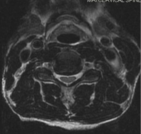 Cervical Myelopathy, OrthoManhattan