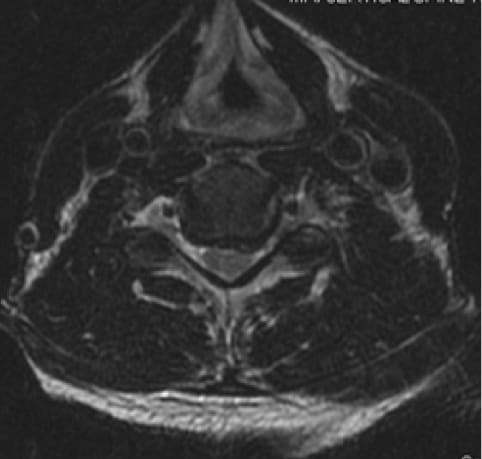 Cervical Myelopathy, OrthoManhattan