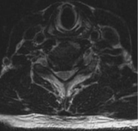 Cervical Myelopathy, OrthoManhattan