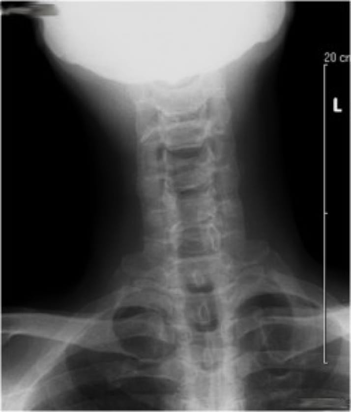 Cervical Myelopathy, OrthoManhattan