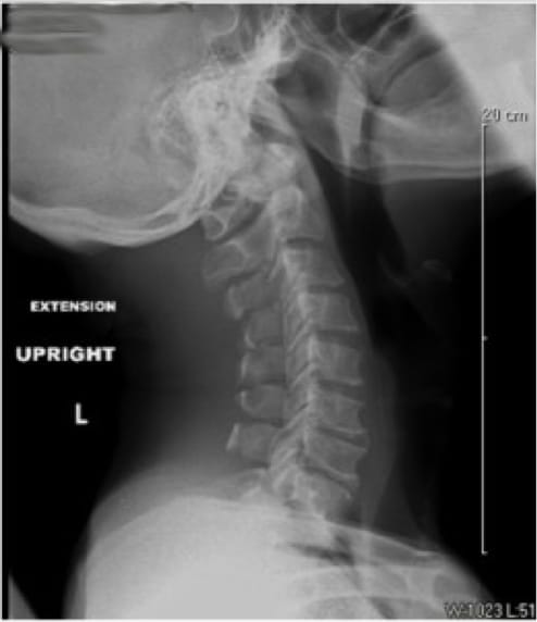 Cervical Myelopathy, OrthoManhattan