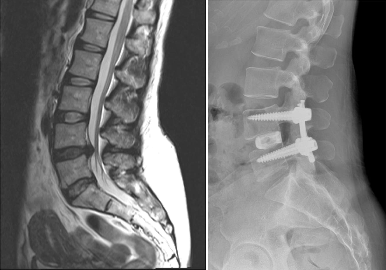 Degenerative Disc Disease