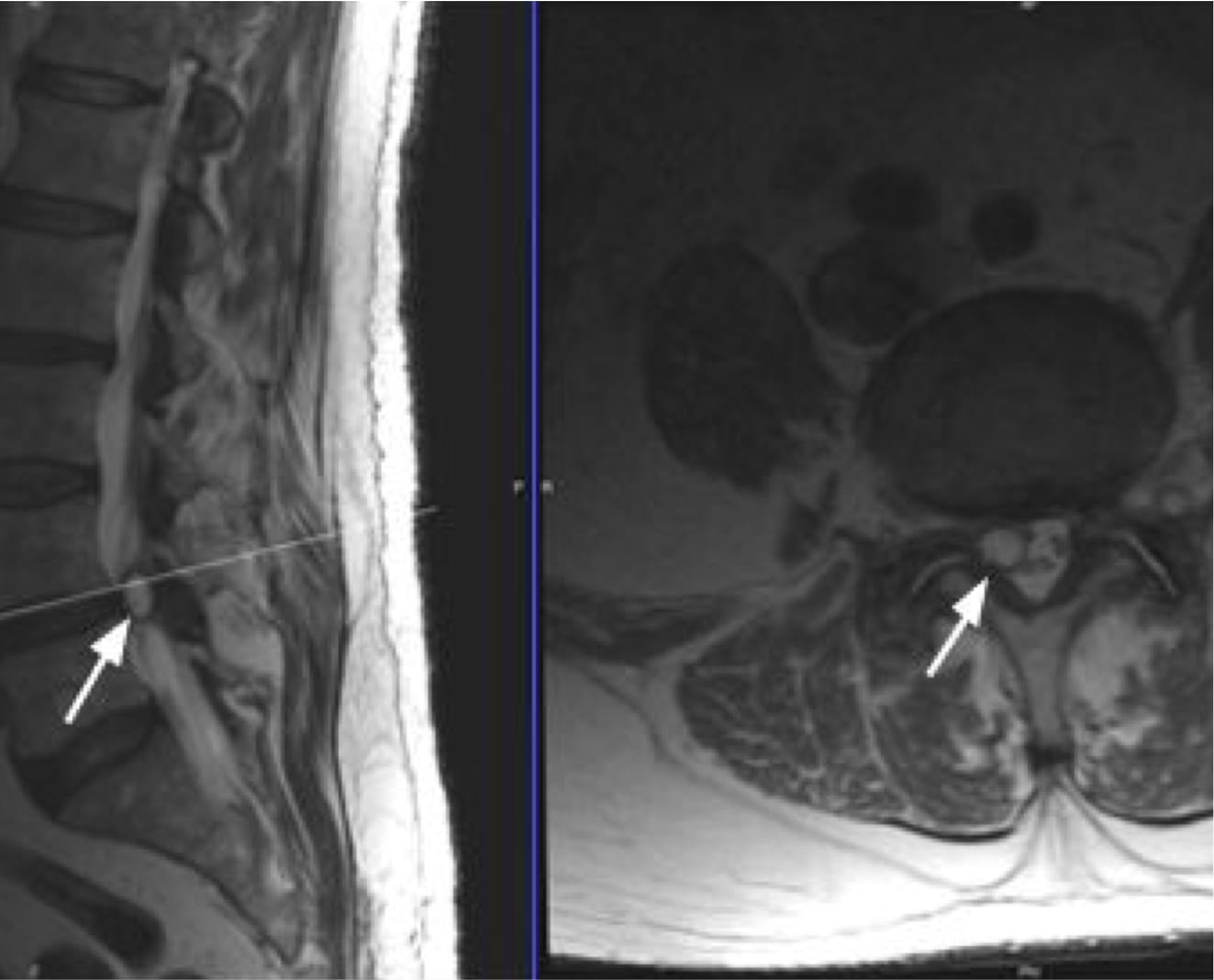 Facet Cyst, OrthoManhattan in New York