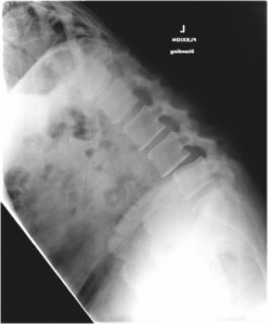 Grade 1 Spondylolisthesis, OrthoManhattan