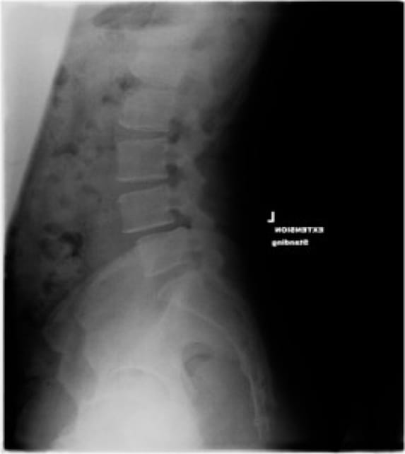 Grade 1 Spondylolisthesis, OrthoManhattan