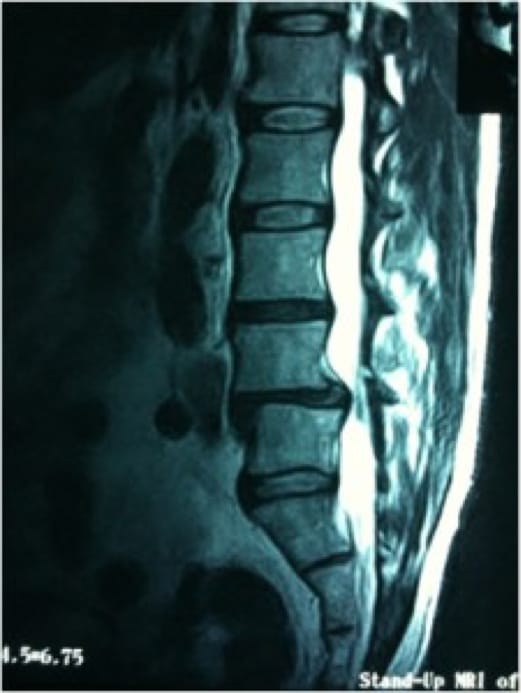 Grade 1 Spondylolisthesis, OrthoManhattan