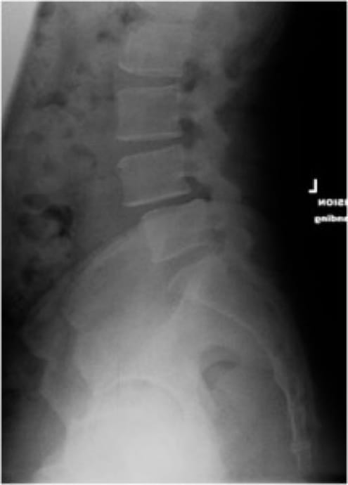 Grade 1 Spondylolisthesis, OrthoManhattan