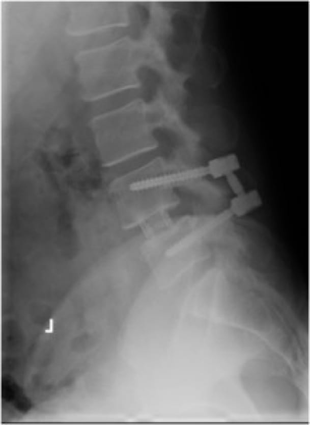 Grade 1 Spondylolisthesis, OrthoManhattan