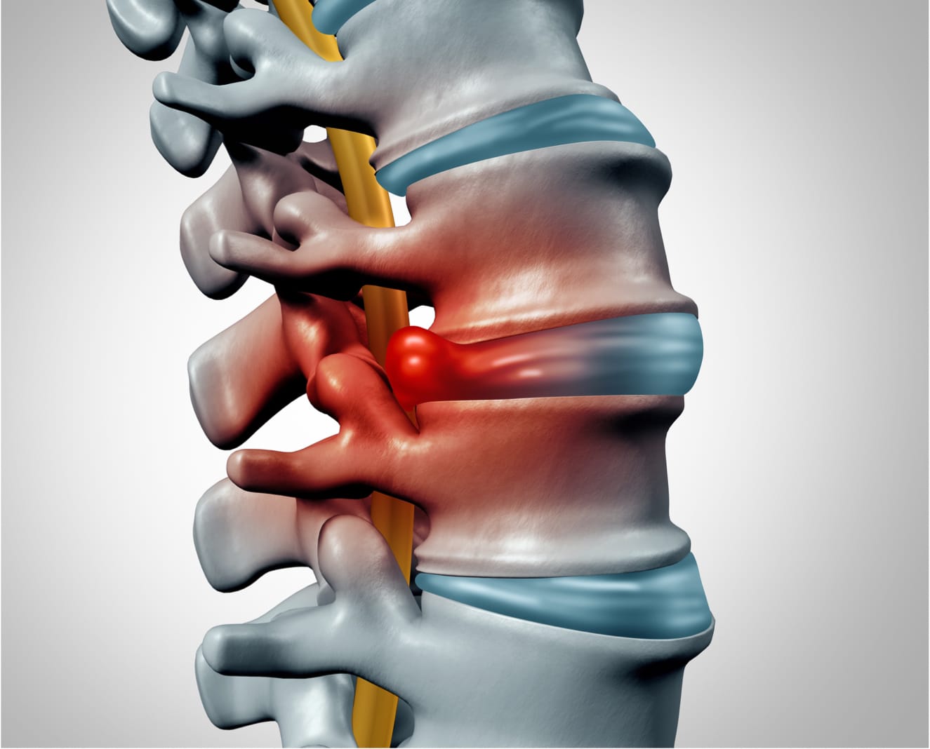 Herniated Disc Surgery NYC