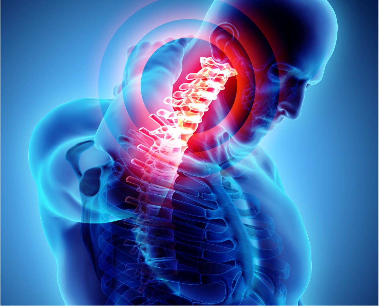 Kyphosis Treatment