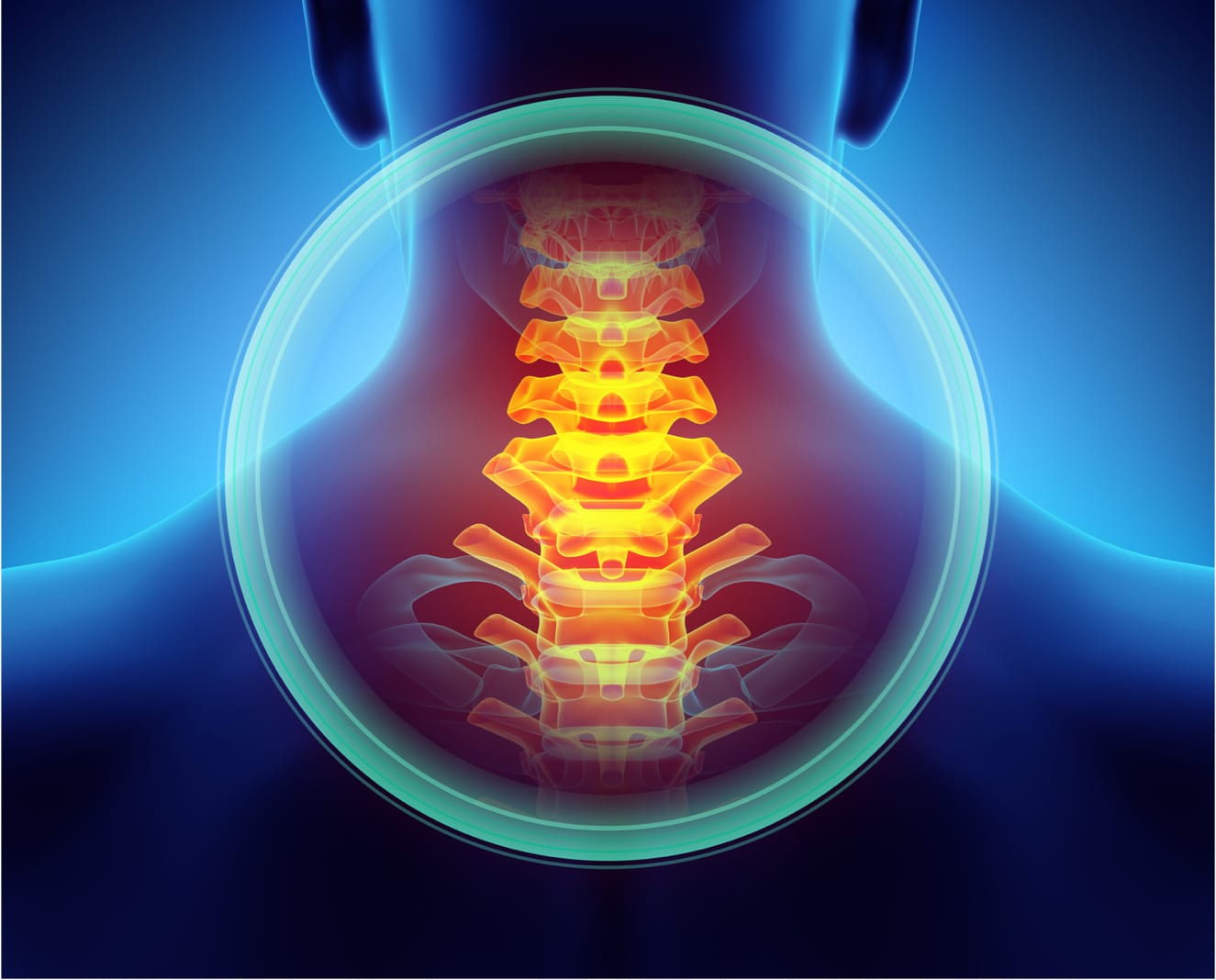 Lumbar Facet Cyst Treatment