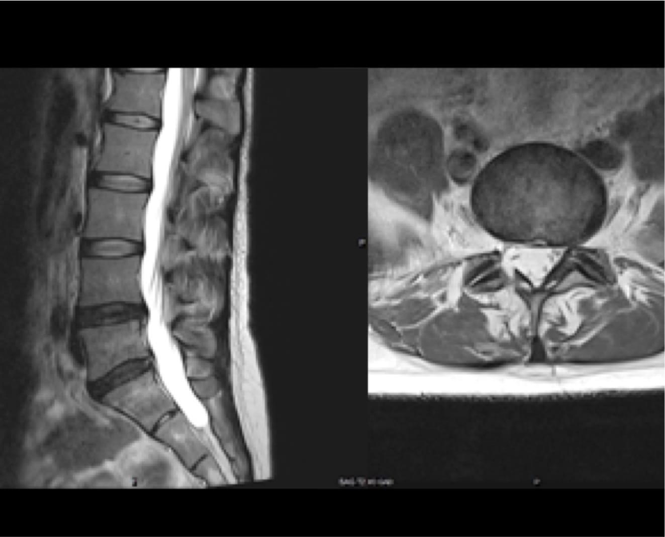 Lumbar Spine Mri Bulging Disc