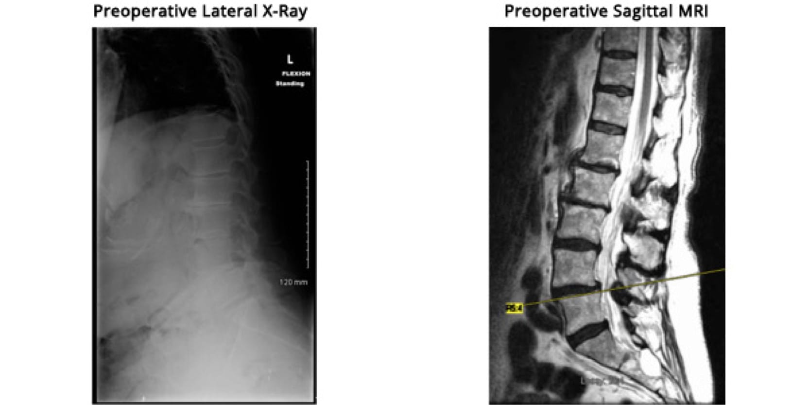 Minimally Invasive TLIF, OrthoManhattan