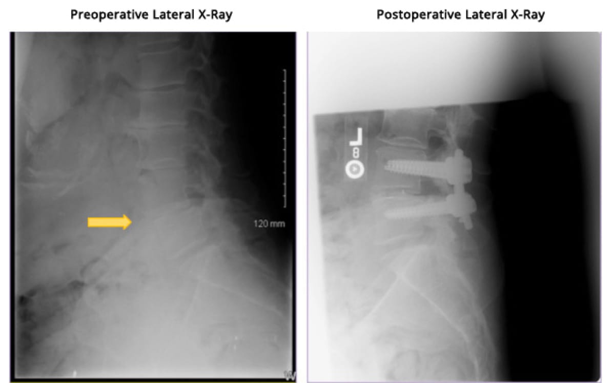 Minimally Invasive TLIF, OrthoManhattan