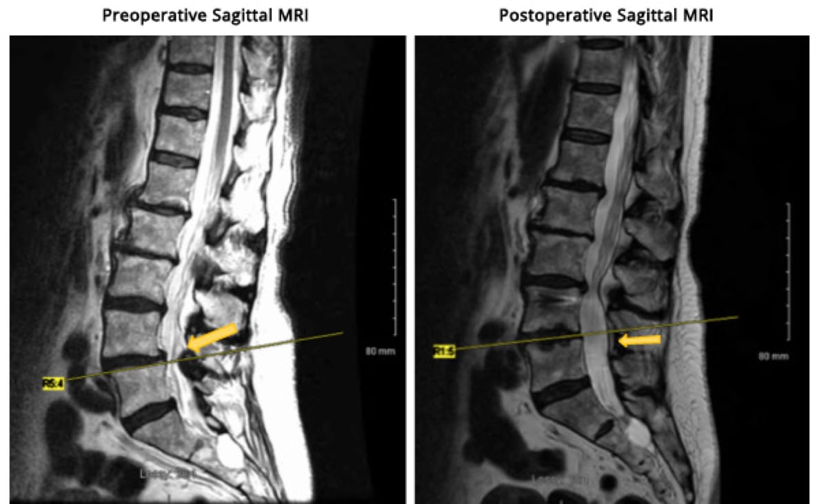 Minimally Invasive TLIF, OrthoManhattan