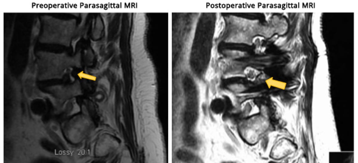 Minimally Invasive TLIF, OrthoManhattan