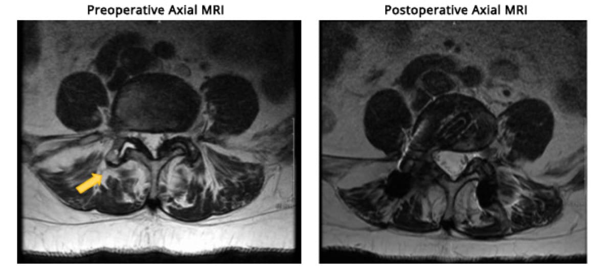 Minimally Invasive TLIF, OrthoManhattan