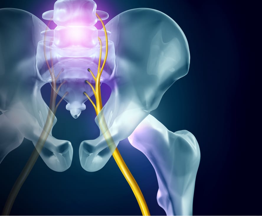 Sciatica Information  Mount Sinai - New York