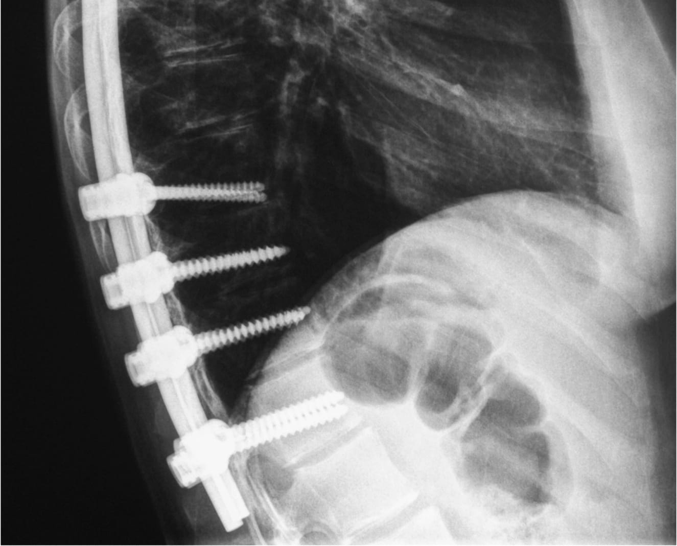 Scoliosis Treatment