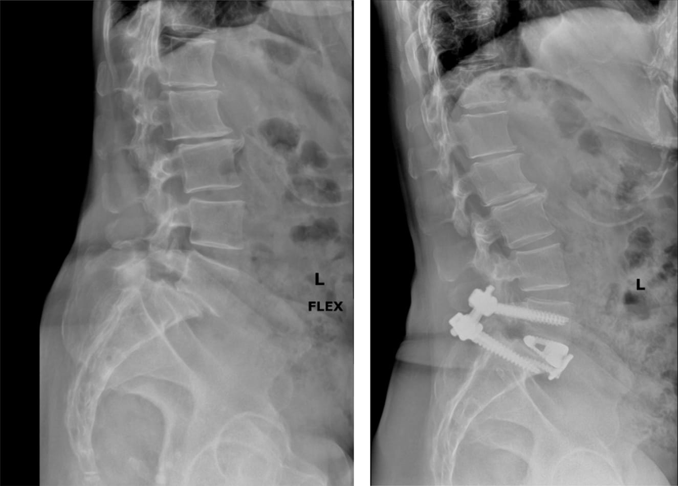 Spondylolisthesis Surgery New York