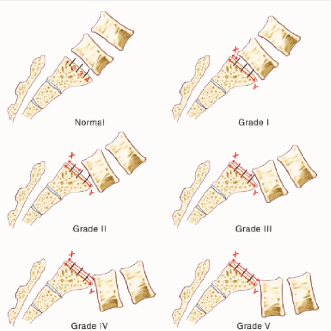 Spondylolisthesis Surgery New York