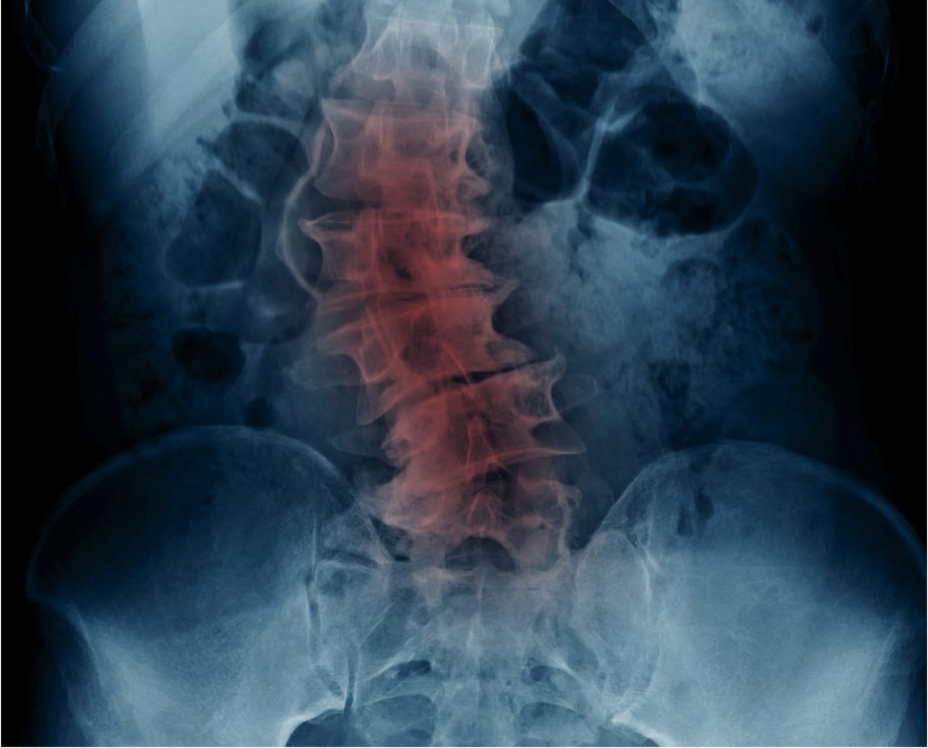 Spondylosis Treatment