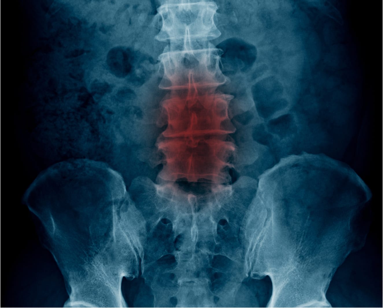 Espondilosis lumbar tratamiento