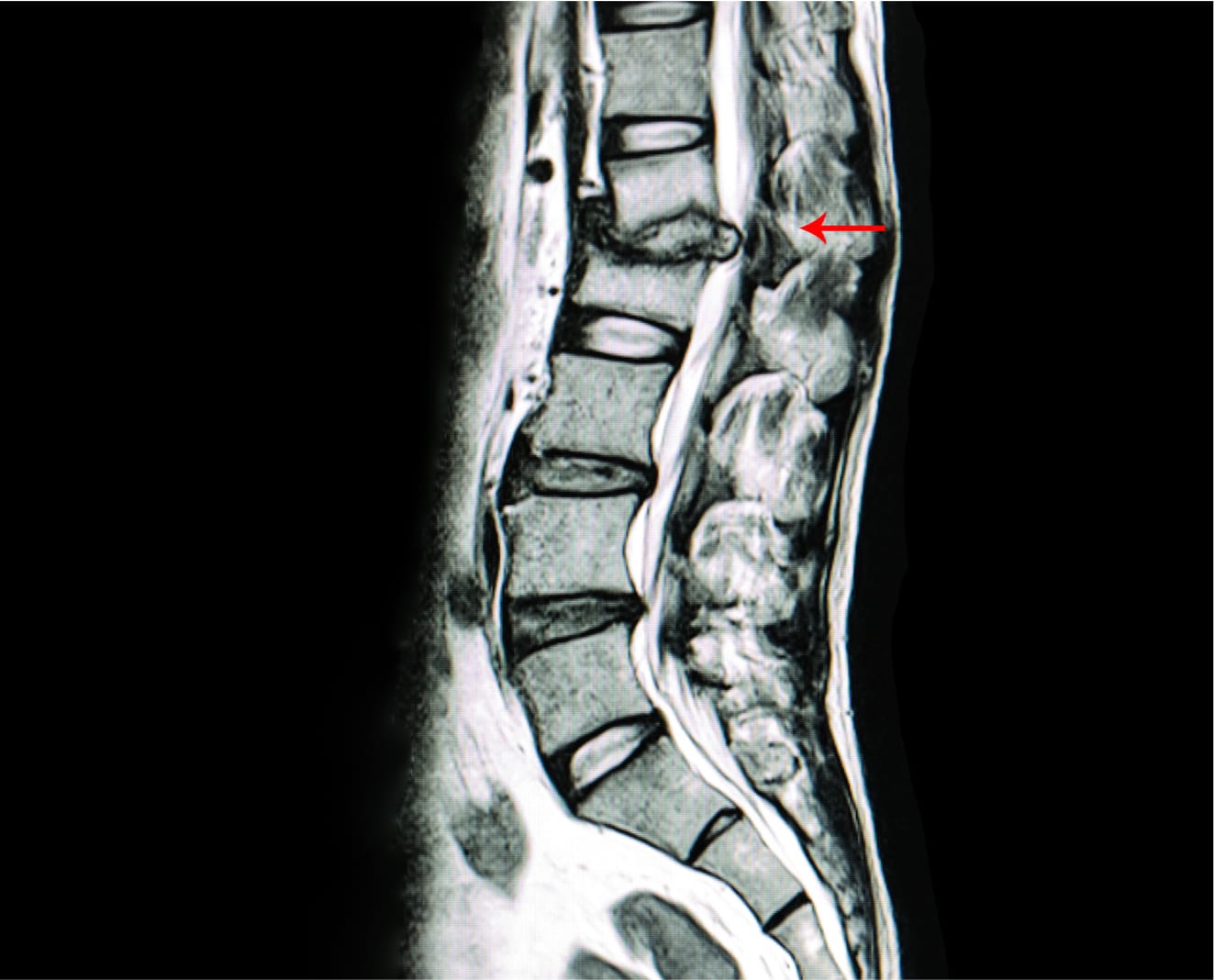 Spinal Stenosis Treatment NYC