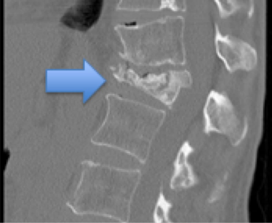 Vertebral Body Fractures and Vertebral Compression Fractures